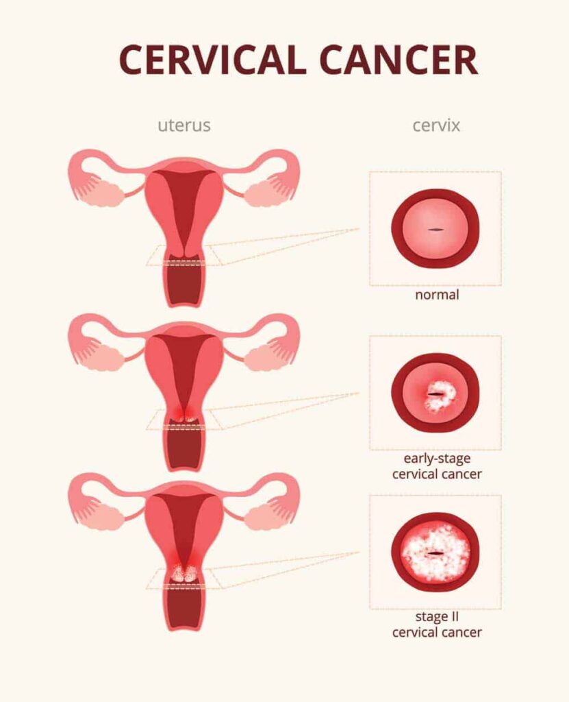 What is cervical cancer? Symptoms of cervical cancer? How to prevent that?
